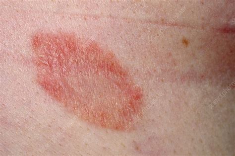 Herald Patch In Pityriasis Rosea Stock Image C014 2707 Science