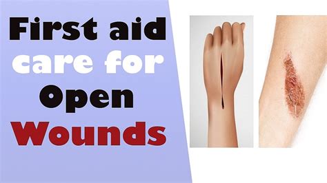 First Aid Care For Open Wounds YouTube