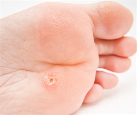 How To Prevent And Treat Corns Calluses And Cracked Heels On The Feet