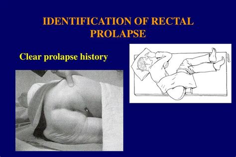 ppt rectal prolapse clinical assessment powerpoint presentation id 3517187