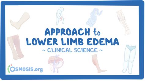 Approach To Lower Limb Edema Clinical Sciences Osmosis Video Library