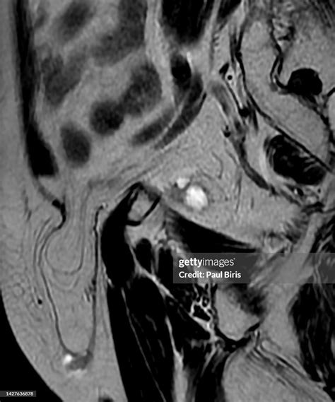 Diagnosis Of Inguinal Region Hernias With Sagittal T2 Mri Image High