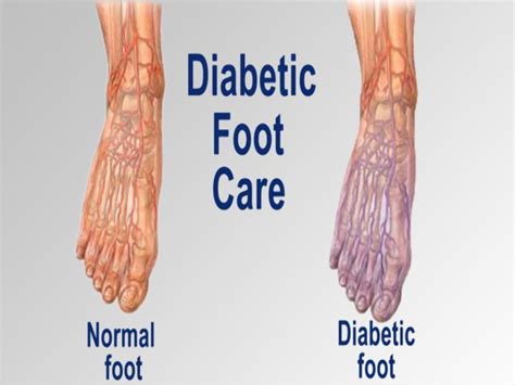 Diabetics With Foot Pain Find Relief With Non Viral Gene Therapy