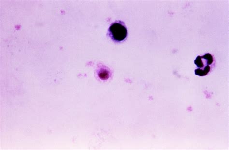 Free Picture Thin Film Micrograph Ring Forms Gametocytes Plasmodium Falciparum