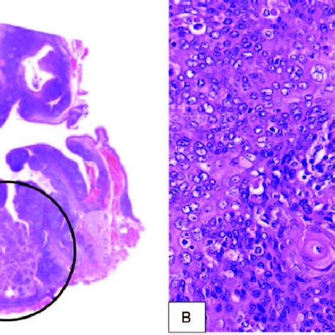 Histopathological Findings Squamous Cell Carcinoma Black Circle In