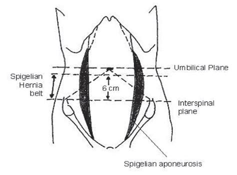 Ventral Hernia The Operative Review Of Surgery