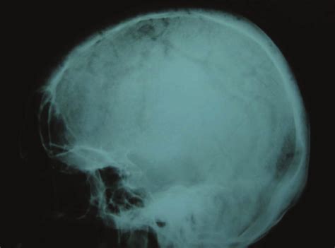 X Ray Of The Skull Showing Multiple Osteolytic Lesions In The Bony