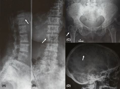Anteroposterior A And Lateral View B Spine Radiograph Showing