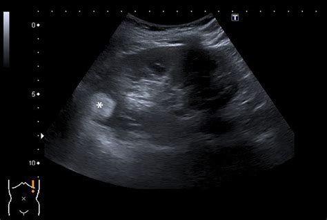 Kidney Ultrasound Tumor