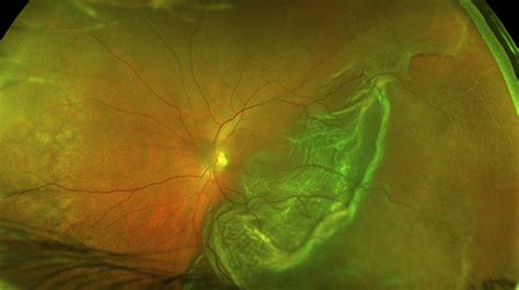 Rhegmatogenous Retinal Detachment Widefieldoptos Retina Image Bank
