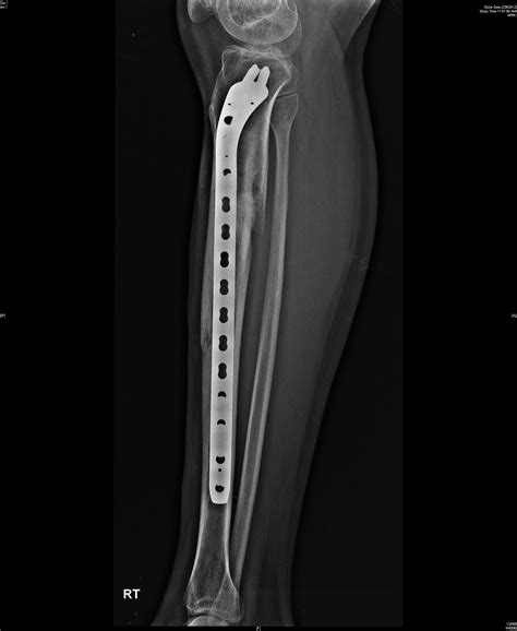 Biological Fixation Comminuted Fracture Proximal Tibia And Shaft