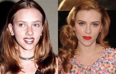 Scarlett Johansson Before And After Plastic Surgery Celebrity Plastic