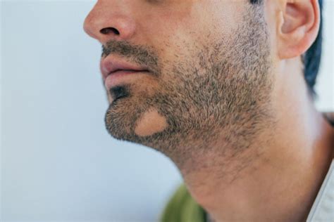 Alopecia Barbae And Its Effects On Your Beard