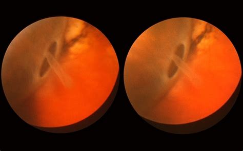 Retinal Break At Site Of Lattice Degeneration With Scleral Indentation