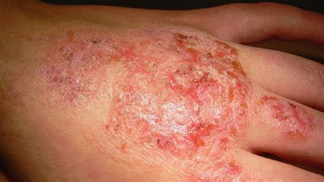 Fast Five Quiz Severe Atopic Dermatitis In Adults