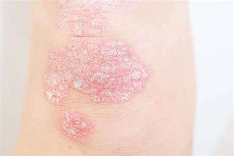 Psoriasis On Legs Stock Photos Pictures And Royalty Free Images Istock