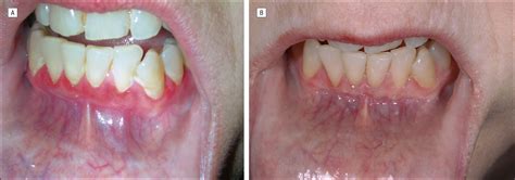 Successful Treatment Of Mucous Membrane Pemphigoid With Etanercept In 3