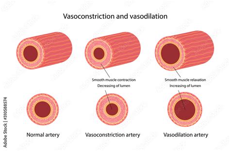 Arterial Vasoconstriction And Vasodilation Comparison Illustration Of Normal Constricted And