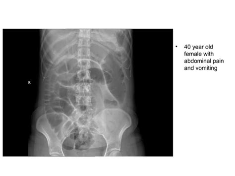 Introduction To Abdominal X Ray Interpretation