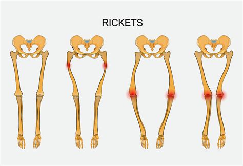 Rickets In Kids Reasons Signs Diagnosis And Remedies