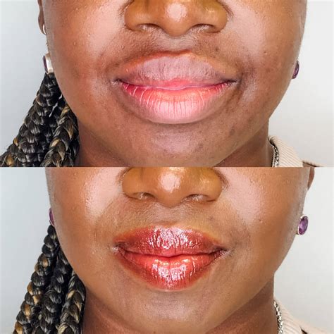 Lip Issues Forever Young Laser And Skin Center Wellesley Ma