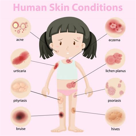 90 Skin Rashes In Children Illustrations Royalty Free Vector Graphics
