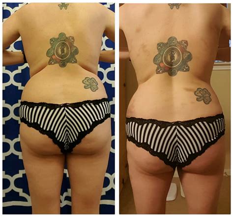 The Fasciablaster® Can Help You Lose Weight Where You Want This Woman Was Able To Smoothen Out