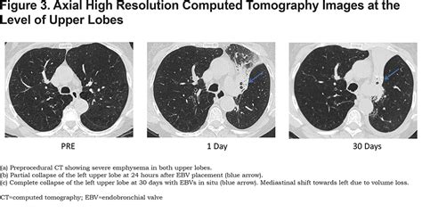 Bronchoscopic Lung Volume Reduction Using Endobronchial Valves Imaging