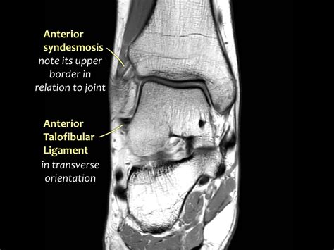 Foot Muscles Mri Anatomy Mri Anatomy Of Ankle Radiology Case