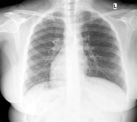 When comparing all anomalies of the cardiovascular system, the heart is located to the right of about 3% of people. Chest X-ray (PA view) showing dextrocardia. | Download ...