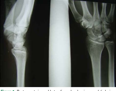 Figure From Lunate Intraosseous Ganglion Cysts And Chronic Wrist Pain Reporting Six Cases