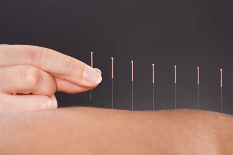 Acupuncturists Near Me At Arc Acupuncture And Physical Therapy