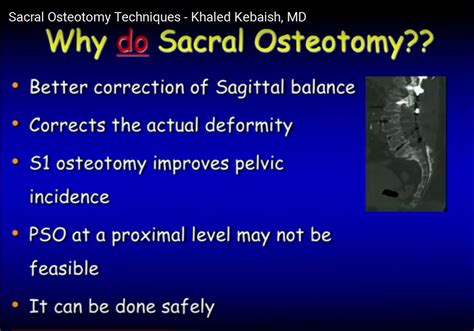 Sacral Osteotomy Techniques —