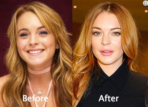 Lindsay Lohan Plastic Surgery Before And After Photos Katakan