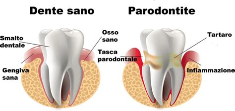 Parodontologia Dentisti In Croazia