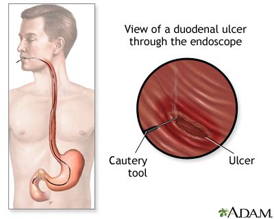 Upper Endoscopy Ulcer