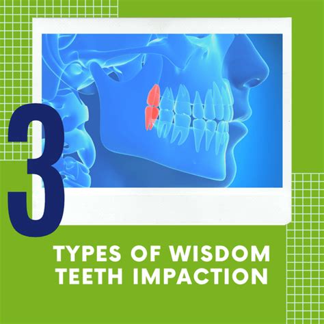 3 Types Of Wisdom Teeth Impaction Tulsa Precision Dental