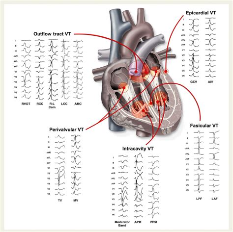 Twelve Lead Electrocardiogram Morphology Of Different Sites Of Origin