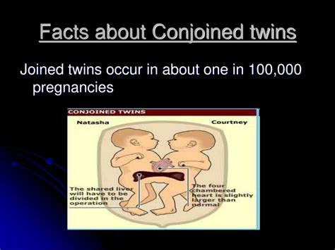 Ppt Conjoined Twins Powerpoint Presentation Id Hot Sex Picture