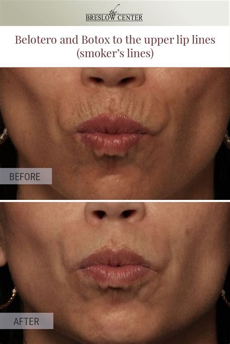 How To Get Rid Of Upper Lip Lines Permanently