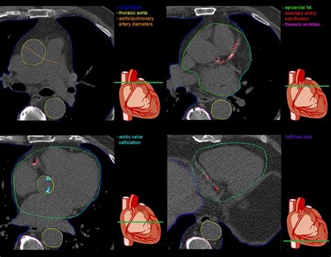Non Contrast Cardiac Ct Much More Than Only Calcium Scoring