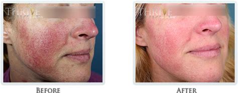 Rosacea Treatment Portland Or Redness Reduction Solutions