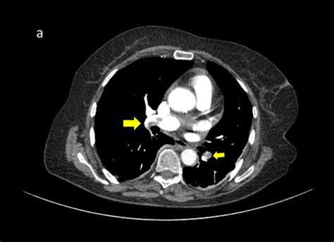 Pulmonary Embolism Thoracic Ct In The Arterial Phase A Showing Small