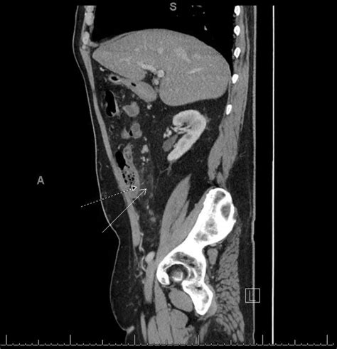 Ct Abdomen And Pelvis With Contrast Sagittal View Revealing
