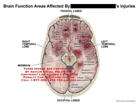 Amicus Illustration Of Amicus Injury Brain Function Affected Frontal Lobes Temporal Midbrain