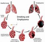 Can Smoking Marijuana Cause Emphysema Pictures