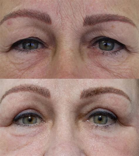 Eye Rejuvenation Surgery Cutis Dermatology
