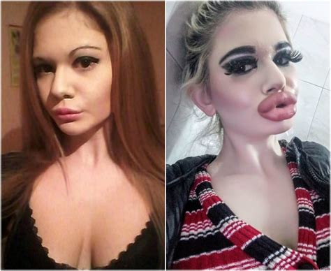 A Bulgarian Girl Had 17 Lip Augmentation Surgeries And Wants More Demotix