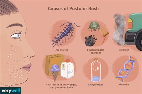 Pustular Rash Causes Symptoms And Treatments