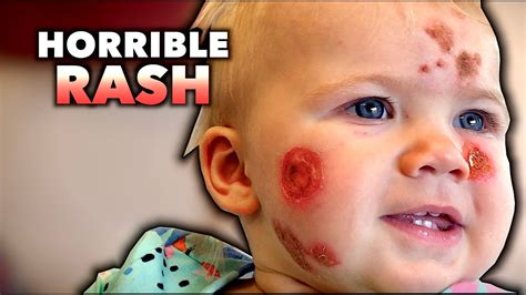 Horrible Rash What Could It Be Special Announcement Dr Paul